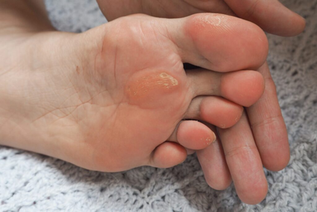 Best PainFree Shoes for Metatarsalgia 2023 Buying Guide & Reviews